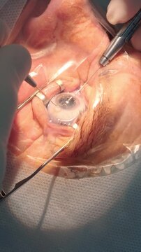 Professional ophthalmologist performing cataract removal and intraocular lens (IOL) implantation under a surgical microscope in an operating room.