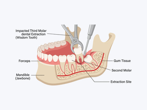 Impacted lower wisdom tooth extraction with forceps in a jaw cross section