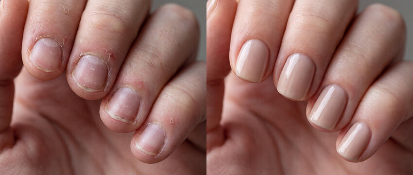 Professional Nail Care Transformation Showing Before Dry Cuticles and After Elegant Glossy Nude Gel Polish Application