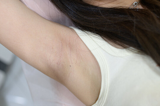 Close-up of Underarm Skin with Hair Removal and Slight Redness on Female Arm