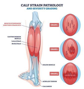 Calf strain pathology grading visual shows gastrocnemius, soleus, and Achilles tendon with grade 1 3 tear stages, mapping injury sites and anatomy. Outline diagram