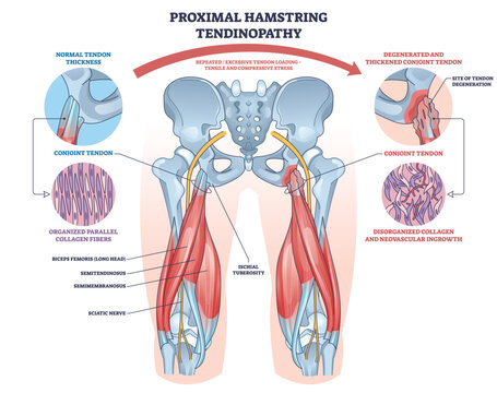 Proximal hamstring tendinopathy illustrated, hip joint, hamstring tendons, and sciatic nerve show overuse stress leading to tendon degeneration and pain near ischial tuberosity. Outline diagram