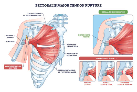 Pectoralis major tendon rupture anatomy shows the shoulder joint, retracted muscle, and torn tendon, clarifying injury stages and site. Outline diagram