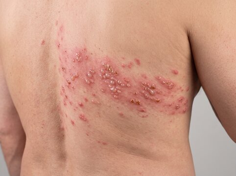 Herpes Zoster (Shingles) &ndash; Unilateral Dermatomal Vesicular Rash