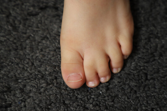 Close-up of a child's bare foot with partial syndactyly of two adjacent toes, showing naturally webbed toes and skin texture on a dark carpet.