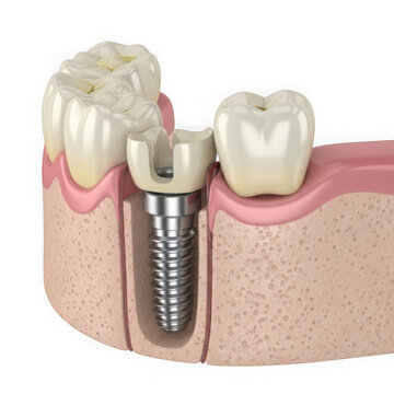Dental implant showing a metal screw inside the human jaw bone and teeth isolated on transparent background