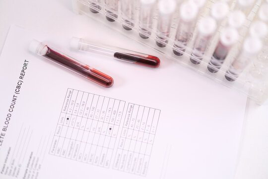 Glass blood sample tubes rest on printed laboratory report beside clear test rack, showing dark red specimens, reference tables, and clean clinical workspace for diagnostics, testing, and research