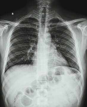 High contrast chest radiograph demonstrating lung field opacities and pulmonary vascularity.