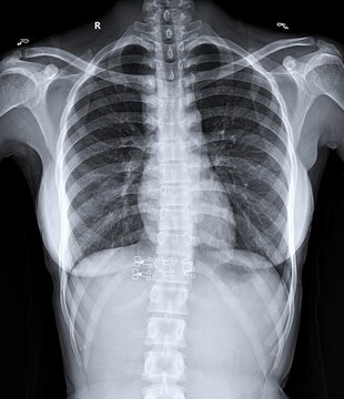 Standard posteroanterior PA chest radiograph demonstrating lung parenchyma and cardiac contour.