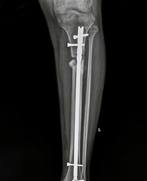 Radiograph of upper shaft tibia showing proximal locking screws of intramedullary nail.