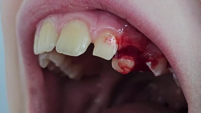 Dental procedure results in bleeding following tooth extraction