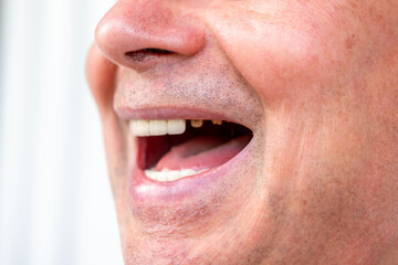 Fototapeta premium closeup senior man smiling showing dental bridge and natural teeth, partial denture visible, mixed teeth, oral health, dental prosthetics, emotional smile, stomatology, before and after open-mouthed