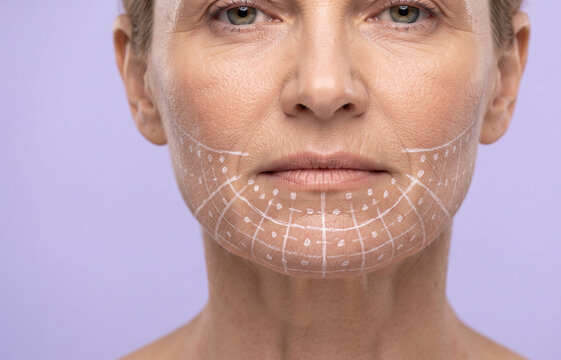 Close-up of a mature woman's lower face marked with white grid lines and dots for cosmetic contouring or thread lifting.