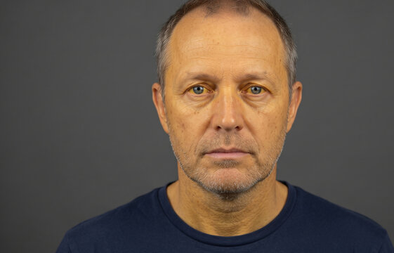 Frontal portrait of middle aged man showing jaundice yellowing of eyes and skin