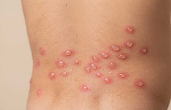 Close up of human back skin with chickenpox varicella fluid filled blister vesicles