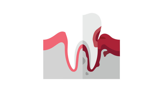Gum inflammation and healthy gingival tissue comparison showing periodontal disease progression flat vector illustration for stomatology education
