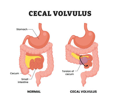 Cecal volvulus labeled diagram, educational medical poster design healthcare scheme, normal and twisted cecum comparison. Labeled stomach, cecum, small intestine and torsion of cecum