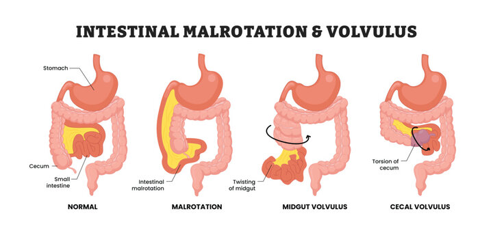 Intestinal malrotation and volvulus labeled diagram, educational medical poster design healthcare scheme, normal anatomy and intestinal rotation disorders. malrotation, midgut volvulus, cecal volvulus