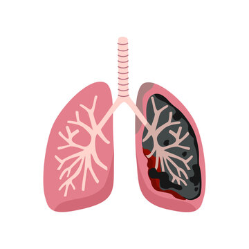 Diseased Lung cancer in flat design