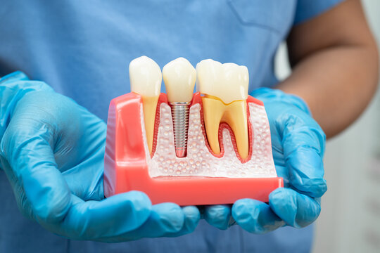 Dentist holding dental implant, artificial tooth roots into jaw, root canal of dental treatment, gum disease, teeth model for dentist.