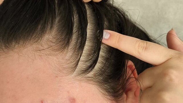Woman touching thinning hair and sparse roots along a wide part, illustrating hair loss, alopecia and reduced hair density.