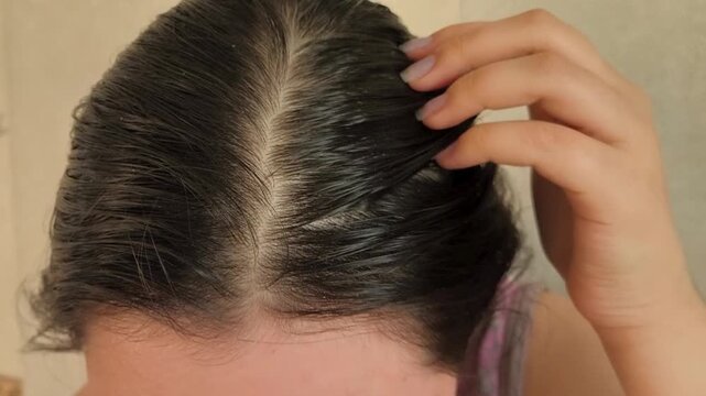 Woman touching greasy hair and scalp, illustrating oily hair, rapid scalp oiliness, excessive sebum production and hair care concerns.