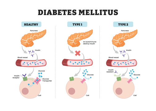 Diabetes mellitus labeled diagram, educational medical poster design healthcare scheme, insulin signaling glucose uptake in type 1 and type 2 diabetes. Pancreas, insulin, receptor, glucose transporter