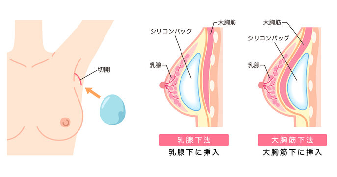 豊胸手術の構造　シリコンバッグを入れた胸