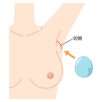 豊胸手術の構造　シリコンバッグを入れた胸