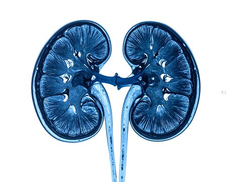 Cross Section Human Kidney Anatomy Radiograph Scan Showing Renal Cortex and Medulla