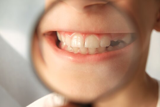Close-up teeth through magnifying glass. Diastema of front teeth. Erupting fang. Smile without cavities. Kid showing white teeth during dental examination, oral hygiene, dental care, health check.