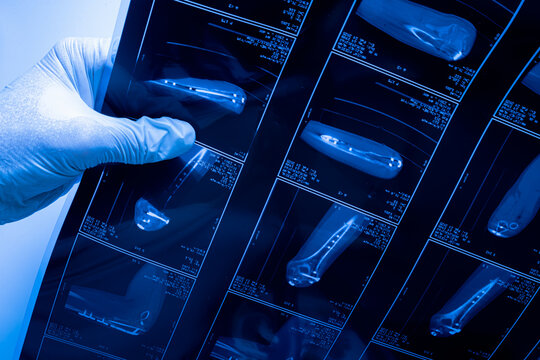Doctor in gloves examining X-ray bone scans on light board, medical radiology and diagnostic imaging concept