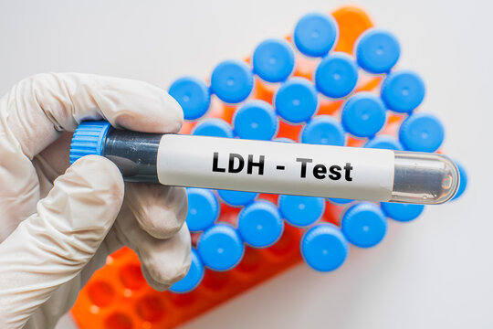 Gloved hand holding LDH test blood tube with laboratory rack