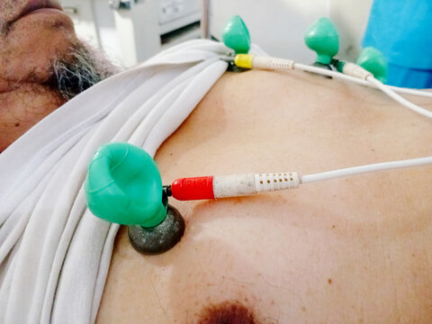 Close-up photo of ECG suction electrodes attached to a patient's chest for an electrocardiogram test in a hospital