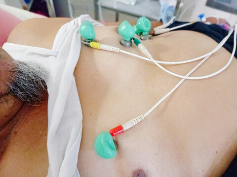 Close-up photo of an electrocardiogram ECG test with suction electrodes on a patient's chest in a clinic