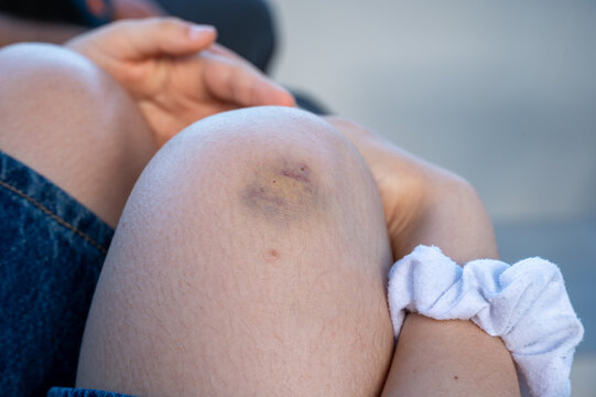 A fresh bruise and graze mark a bent knee with a small tissue held nearby to clean the scrape. An honest everyday injury far from any posed stock cliche.
