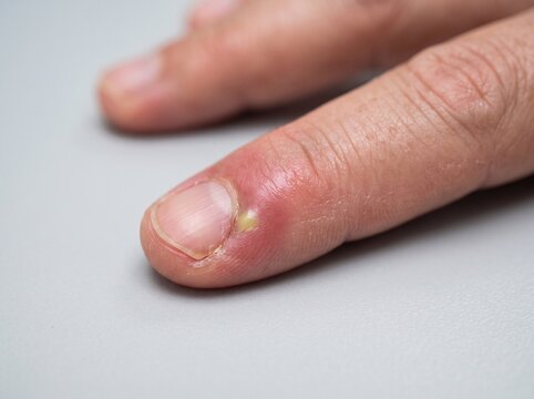 Periungual Abscess in Acute Bacterial Paronychia