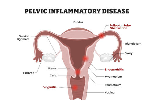 Pelvic Inflammatory Disease labeled diagram, educational medical poster design healthcare scheme, reproductive infection. Labeled fallopian tube obstruction, endometrium, vaginitis, endometritis.