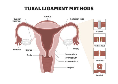 Tubal Ligament Methods labeled diagram, educational medical poster design healthcare scheme, female sterilization procedure. Labeled clipped, tied, cauterized, banded fallopian tube