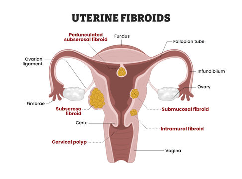 Uterine Fibroids labeled diagram, educational medical poster design healthcare scheme, fibroid classification. Labeled pedunculated subserosal, submucosal, intramural, cervical polyps fibroids