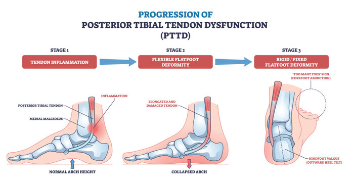 Posterior tibial tendon dysfunction progression shown across three stages, highlighting foot bones, tendon, and arch collapse with arrows and labels. Outline diagram