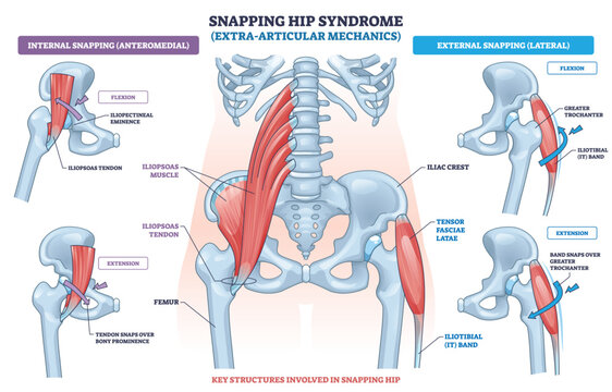 Snapping hip extra-articular mechanics, iliopsoas tendon and IT band snap over pelvic bone, focus on iliopsoas, iliotibial band, greater trochanter. Outline diagram