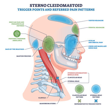 Sternocleidomastoid trigger points and referred pain patterns on a head profile, highlighting SCM muscle, trigger points, and shaded pain zones across head, face, and ear, transparent background.