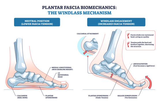 Plantar fascia biomechanics show the windlass mechanism raising the arch as the hallux dorsiflexes, plantar aponeurosis tightens between calcaneus and metatarsal head, transparent background.
