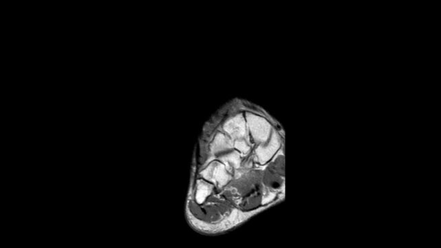 Multi-Planar MRI Scan of Human Right Ankle and Foot Anatomy