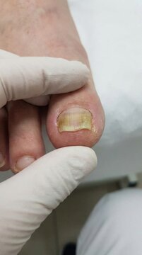 Diseased toe plate: nail fungus, medical exam, clinical inspection, infected keratin, yellow discoloration, podiatry checkup, glove hand, patient treatment, foot hygiene, dermatological condition.