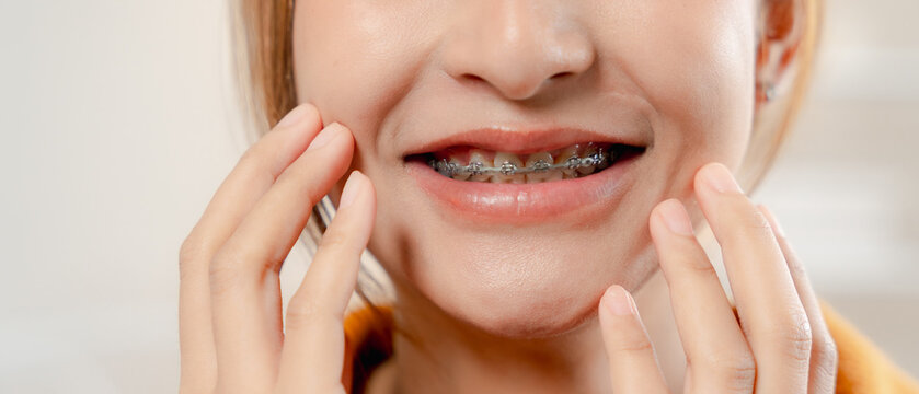 Braces and orthodontic treatment concept. Close-up of a young woman smiling and showing metal braces, with her hands near her cheeks indoors. Dental care, teeth, smile, oral health.