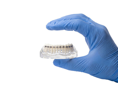 Dentist holding a dental model with metal braces on transparent background for orthodontics education and treatment