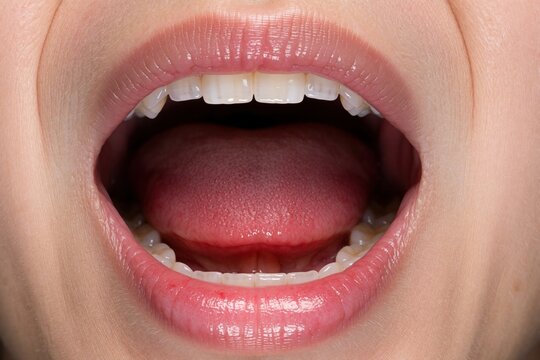 Close up view of open mouth showing sore throat with swollen uvula, red tonsils. Patient throat infection, inflammation flu symptoms. Clinical examination of oral cavity, pharynx, respiratory tract