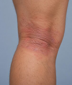 Realistic Flexural Eczema Behind Adult Knee With Dry Scaly Inflamed Skin, Dermatology Clinical Close-Up